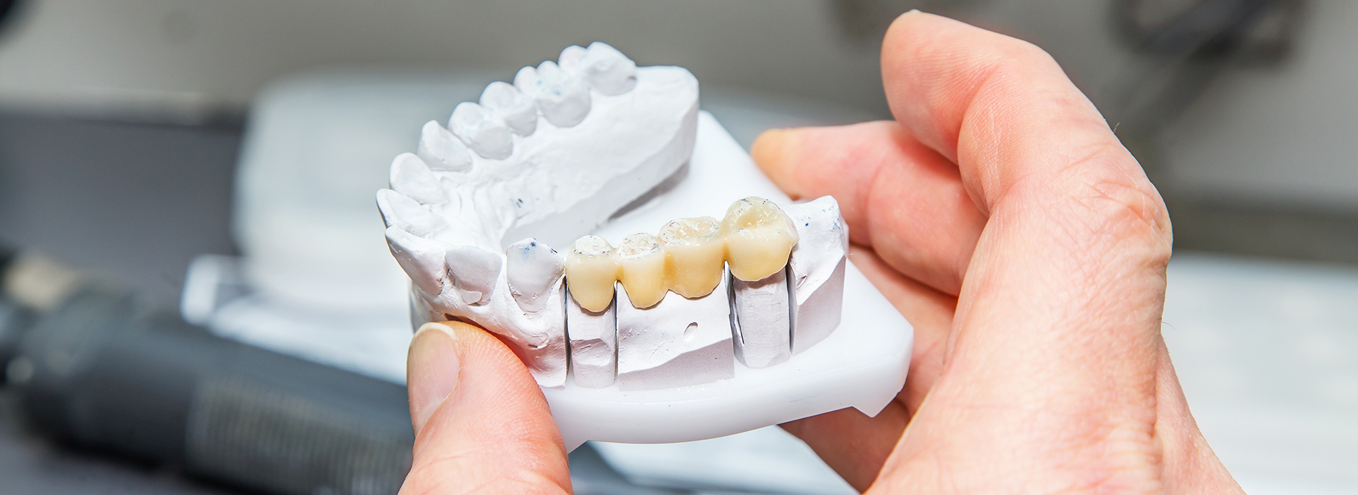 The image shows a person holding a 3D printed model of a human tooth with visible dental implants, likely for educational or demonstration purposes.